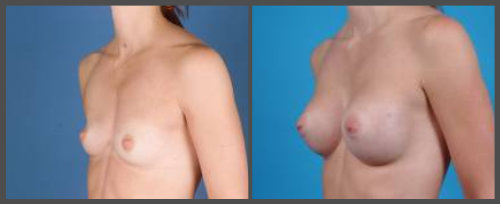 Breast Augmentation With Pectus Excavatum
