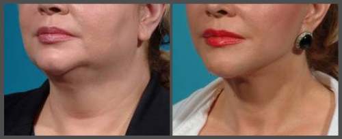 Lower Neck and Face Lift - Dr. Hobar