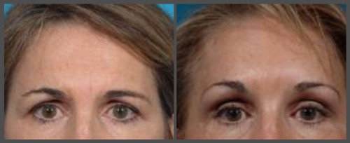 Eyelid Surgery (Blepharoplasty)