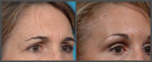 Eyelid Surgery (Blepharoplasty)