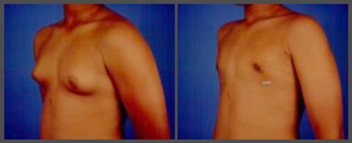 Gynecomastia