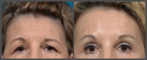 Browlift And Eyelid Surgery (Blepharoplasty)
