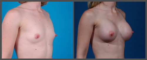 Breast Augmentation - Dr. Hobar