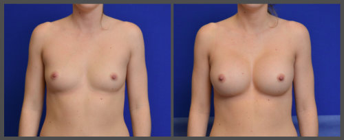 Breast Augmentation - Dr. Hobar