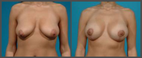 Breast Augmentation With Lift