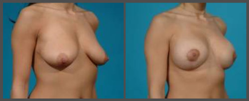 Breast Augmentation With Lift