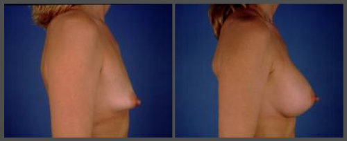 Tubular Breast Deformity Corrected with Saline Augmentation