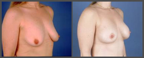 Breast Lift With Small Implant