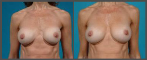 Breast Implant Exchange