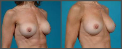 Breast Implant Exchange