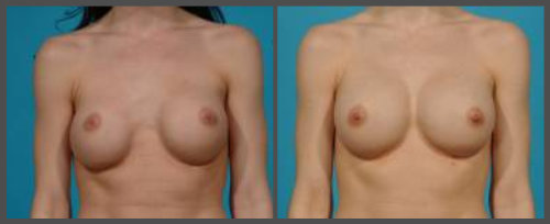 Secondary Breast Augmentation For Repair Of Bottoming Of Implants