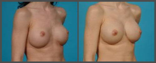 Secondary Breast Augmentation For Repair Of Bottoming Of Implants