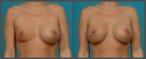 Breast Implant Deflation