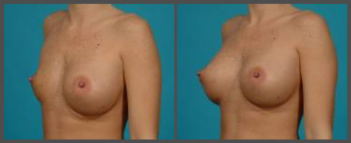 Breast Implant Deflation