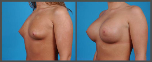 Breast Augmentation - Dr. Hobar