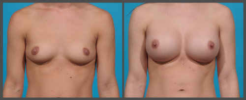 Breast Augmentation - Dr. Hobar