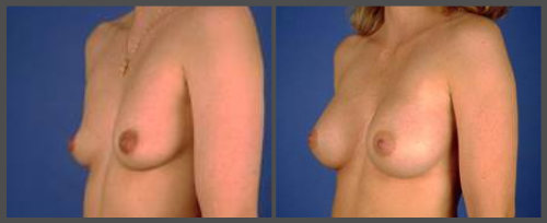 Breast Augmentation - Dr. Hobar