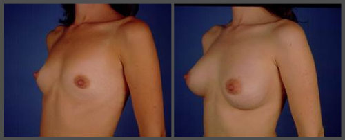 Breast Augmentation - Dr. Hobar