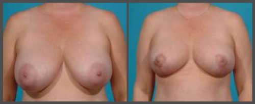 Breast Reduction Surgery