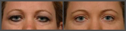 Eyelid Surgery