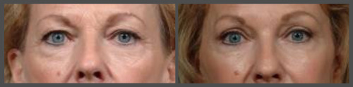 Eyelid Surgery (blepharoplasty)