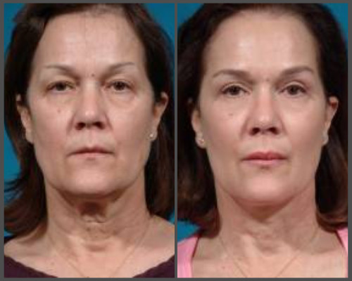 Face-lift - Dr. Hobar