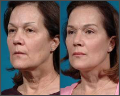 Face-lift - Dr. Hobar