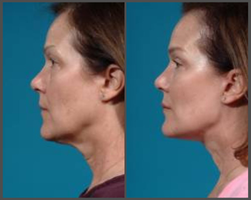 Face-lift - Dr. Hobar