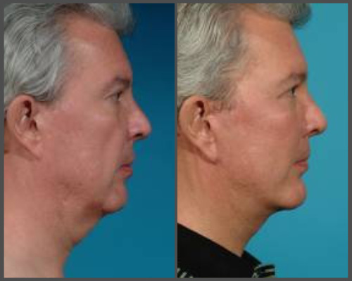 Face-lift - Dr. Hobar