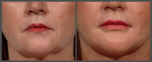 Lip Enhancement