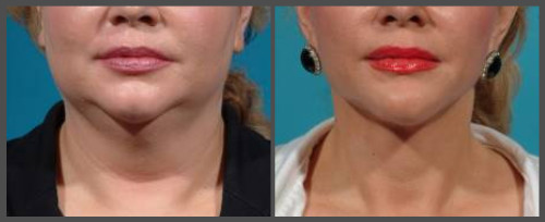 Lower Neck and Face Lift - Dr. Hobar