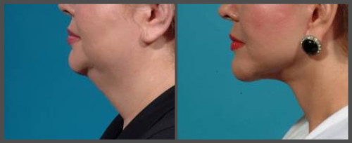 Lower Neck and Face Lift - Dr. Hobar