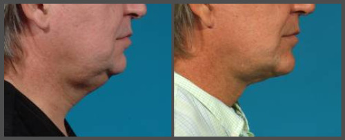 Lower Face and Neck Lift - Dr. Hobar