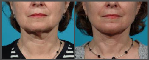 Lower Face and Neck Lift with Fraxel Re:Pair