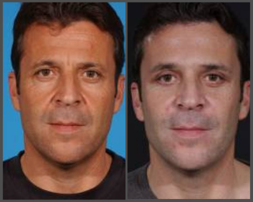 Midface Lift with Blepharoplasty - Dr. Hobar