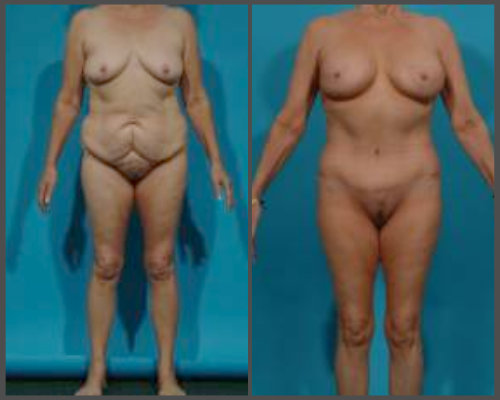 Mommy Makeover, Tummy Tuck and Breast Lift