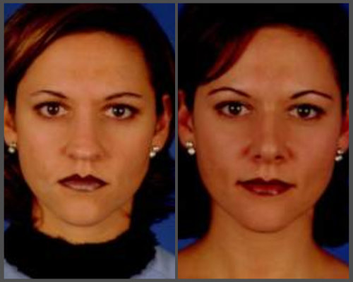 rhinoplasty