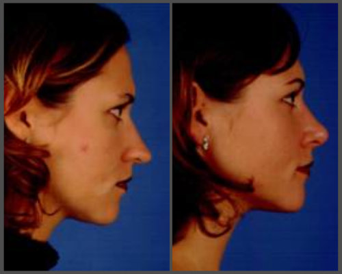 rhinoplasty