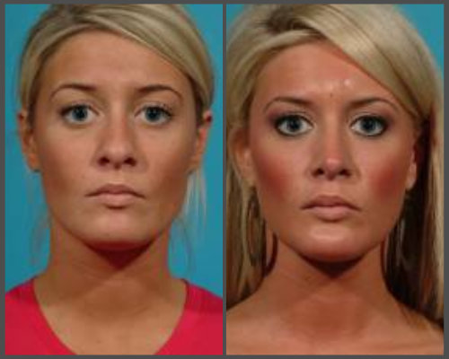 Dr. Hobar - Rhinoplasty