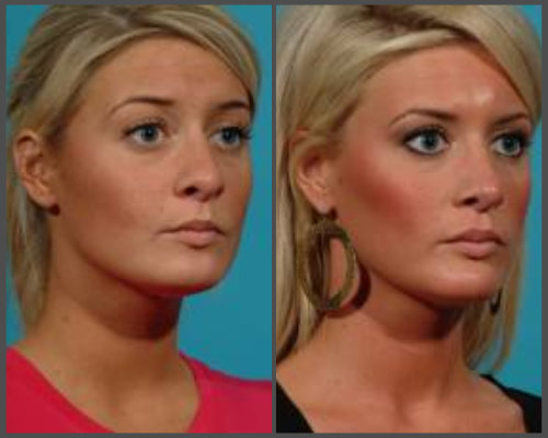 Dr. Hobar - Rhinoplasty