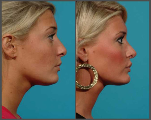 Dr. Hobar - Rhinoplasty