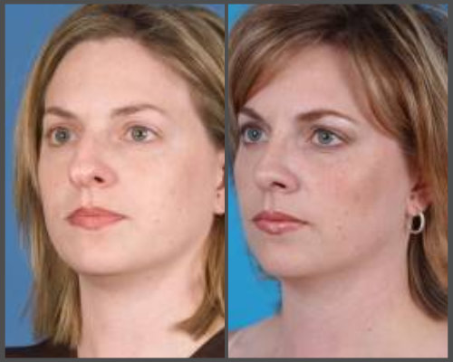 Dr. Hobar - Rhinoplasty