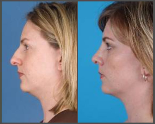 Dr. Hobar - Rhinoplasty