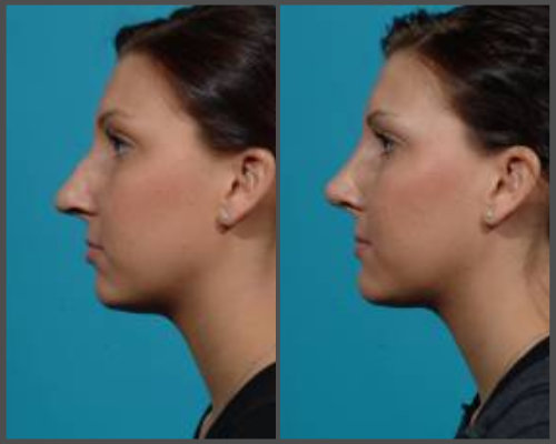 Dr. Hobar - Rhinoplasty