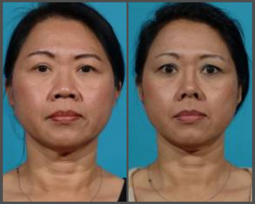 Dr. Hobar - Rib Graft Rhinoplasty