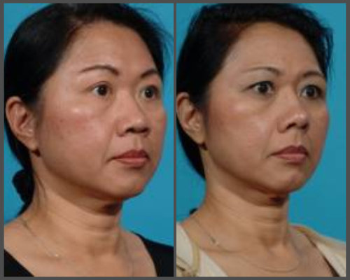 Dr. Hobar - Rib Graft Rhinoplasty