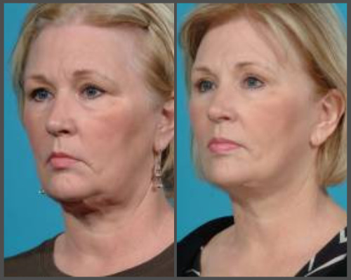 Secondary Facial Rejuvenation