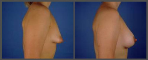 Tubular Breast Deformity Corrected with Saline Augmentation