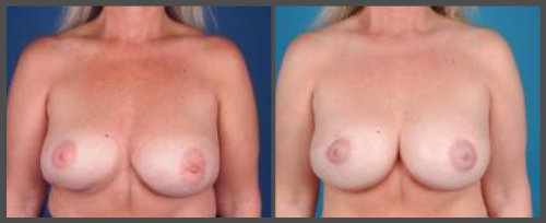Redo Lift and Reposition Implants