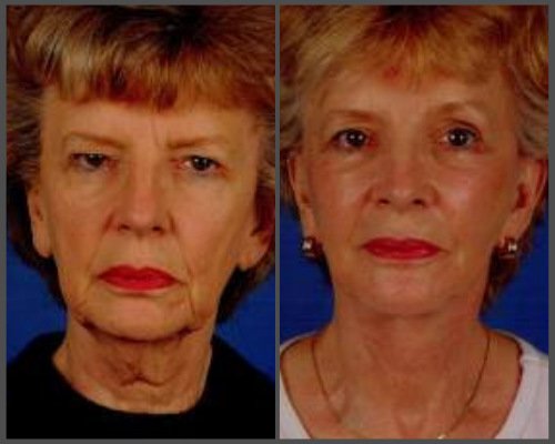 Facelift - Dr. Hobar